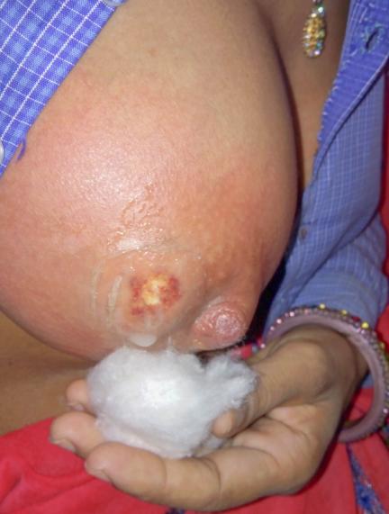 Breast Abscess