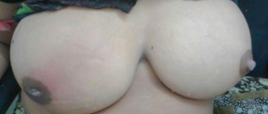 Bilateral Breast Engorgement