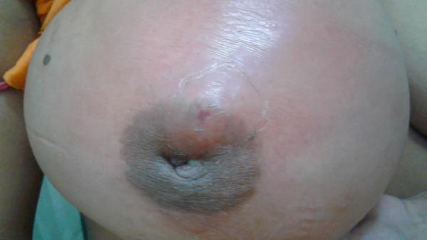 Inverted Nipple Causing Engorgement