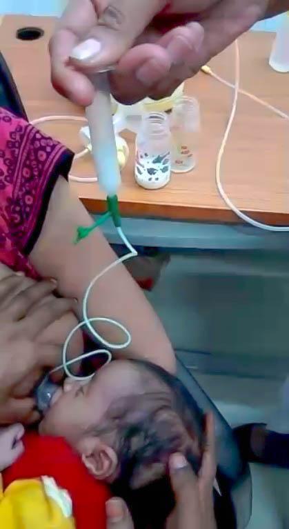 Tube Assisted Breastfeeding