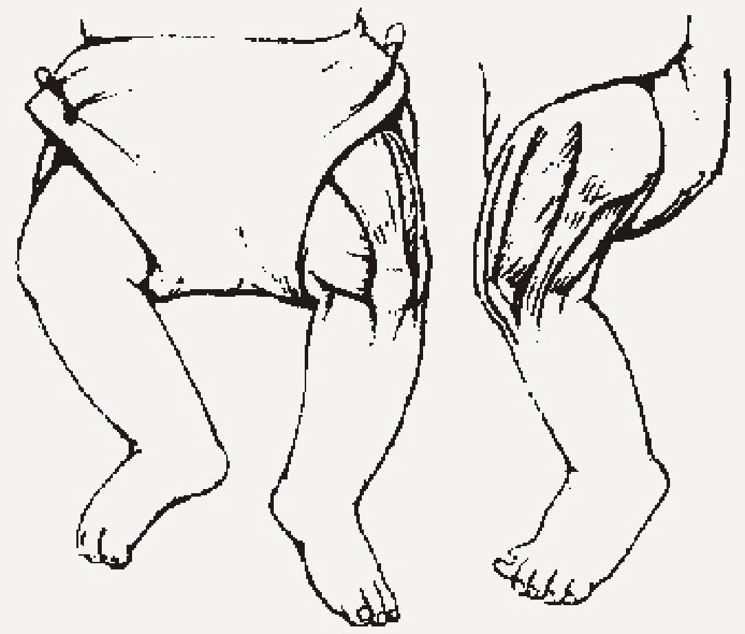 Baby Injection Sites